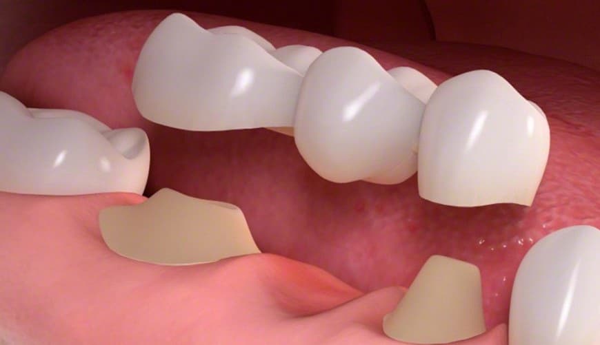 تركيبات الزيركون