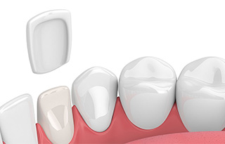 قشور البورسلان والفينير