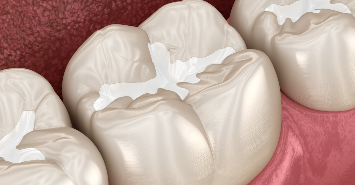 حشوات تجميلية